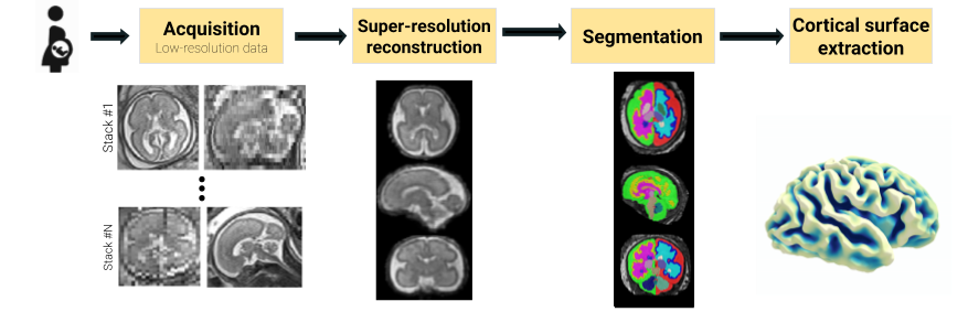 Fetpype workflow from fetal MRI acquisition through reconstruction, segmentation and cortical surface extraction